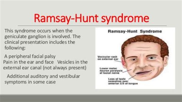 Maladie Ramsay Hunt